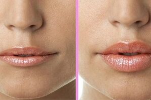 avant et après la procédure de restauration des lèvres